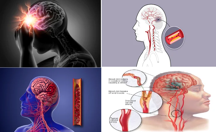 Atacul cerebral vascular reprezintă una dintre principalele cauze de deces în România Colaj  DMS