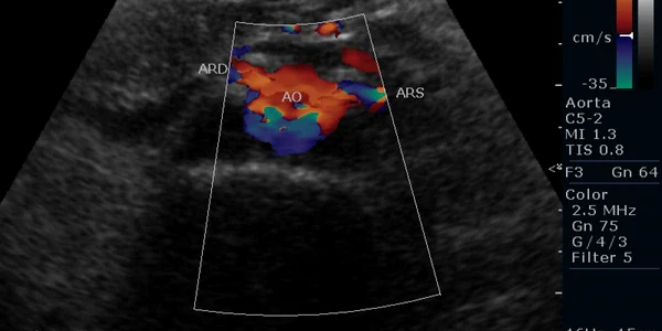 Hipertensiunea arteriala (HTA) reprezintă principala cauză de mortalitate cardio-vasculară