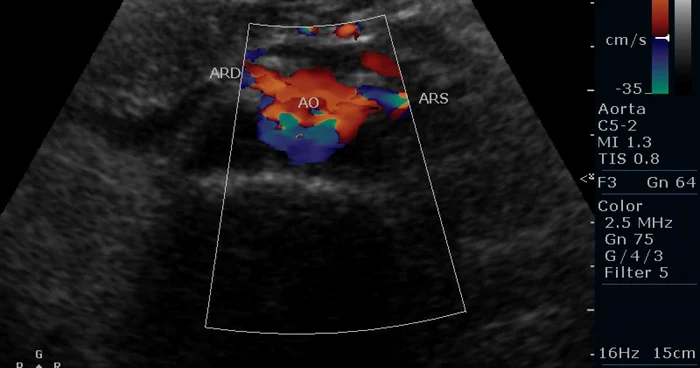 Hipertensiunea arteriala (HTA) reprezintă principala cauză de mortalitate cardio-vasculară