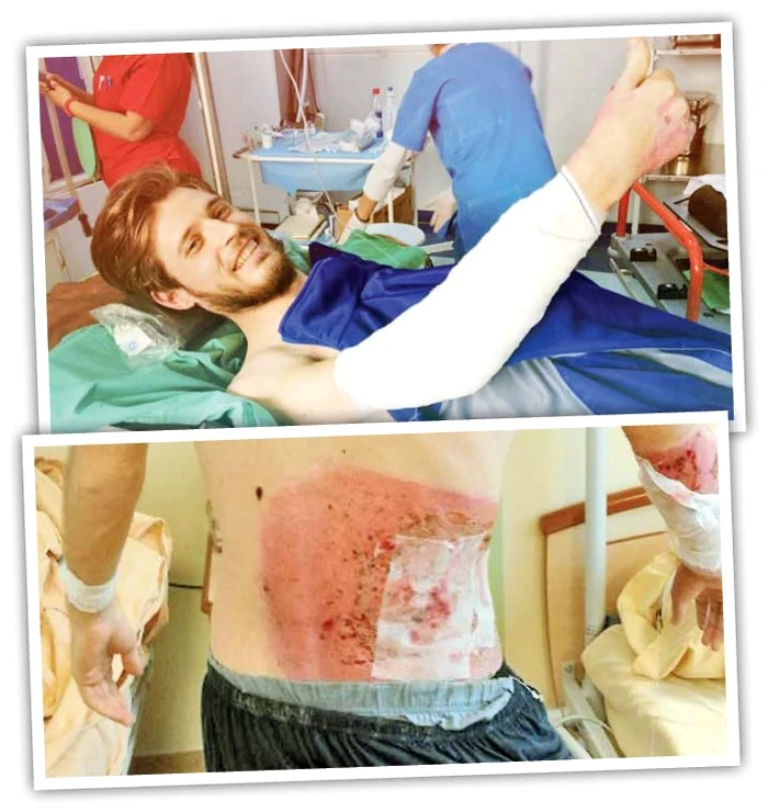 Alex a stat două luni în spital,  după incendiul din Clubul  Colectiv. El a suferit arsuri grave pe mâini şi pe spate