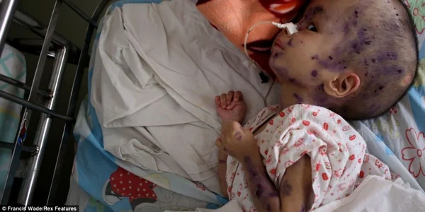 copii afectati de agentul oranj în vietnam