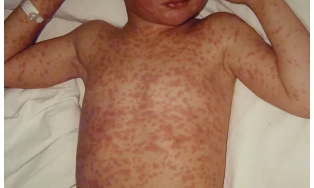 Epidemie de rujeolă în România. Medic: „O maladie cu risc extrem de mare de complicații, poate produce decesul”