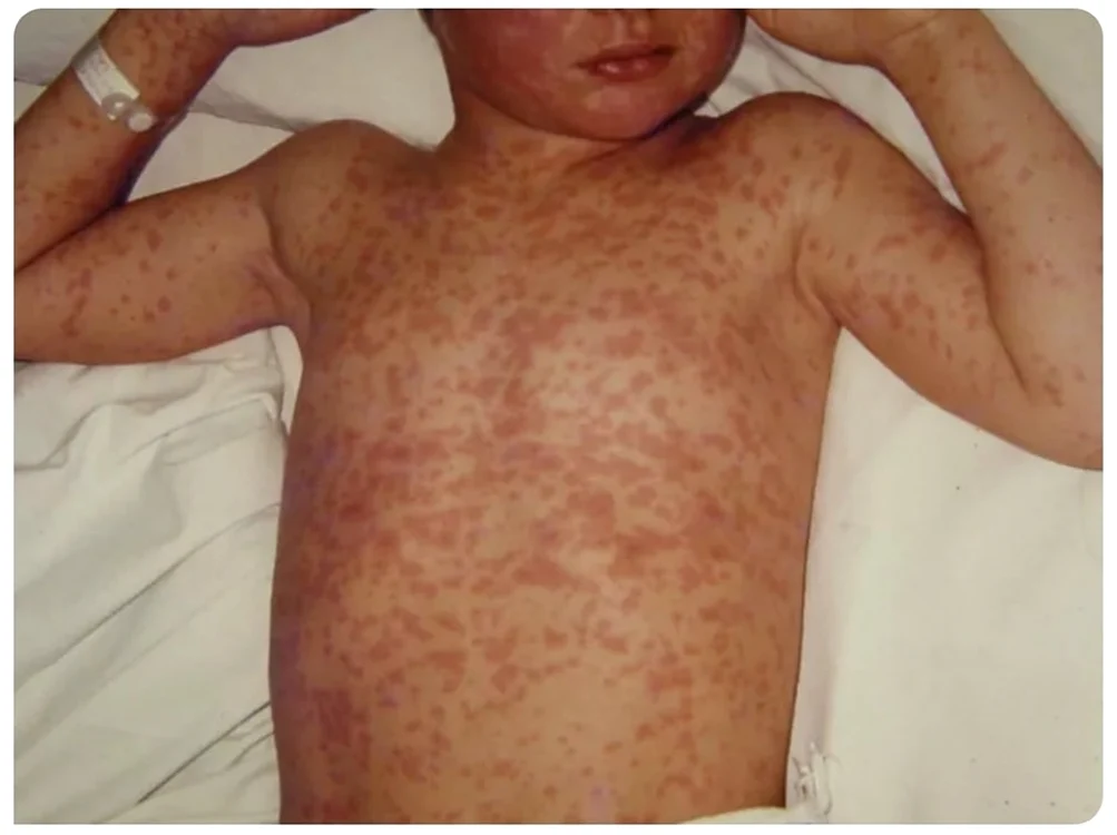 Încă 872 de cazuri noi de rujeolă și un deces, în ultima săptămână - Foto Arhivă