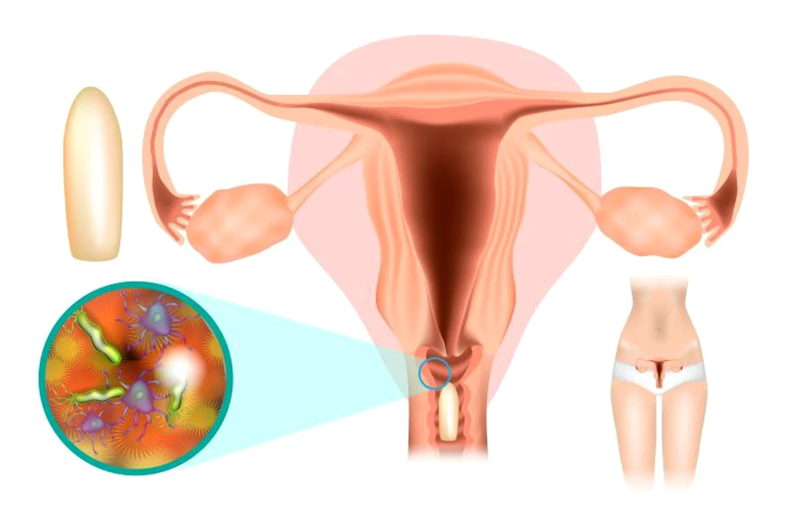 Infecțiile vaginale sunt contactate de multe ori în urma unui raport sexual SURSA SJU Târgu Jiu 