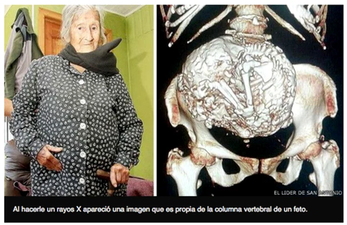 Femeia a descoperit ce purta în ea după ce i s-a făcut o radiografie