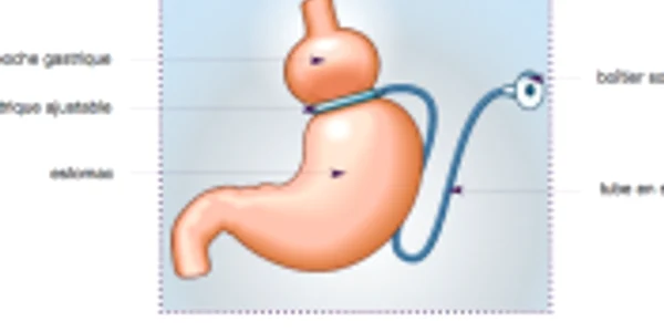inel gastric