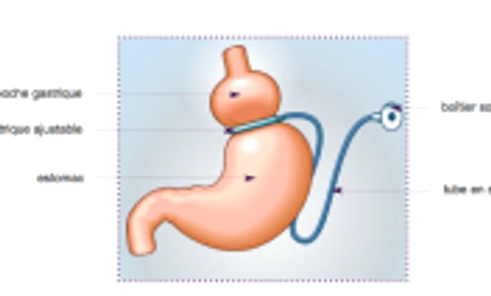 inel gastric