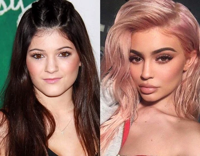Kylie Jenner, înainte şi după ce a trecut prajul medicului estetician 