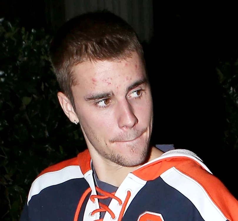 Justin Bieber a explicat pe Instagram motivul pentru care în ultima perioadă a suferit de acnee, oboseală și o stare generală de rău Foto: Profimedia
