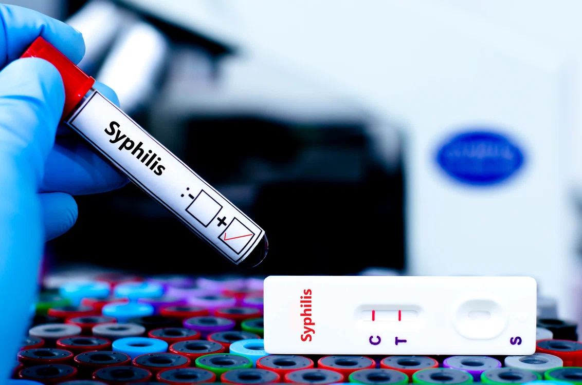 Eprubeta cu sânge infectat cu sifilis