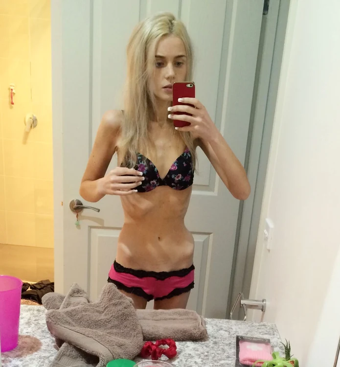 Elle devenise anorexică şi cântărea doar 35 de kilograme/FOTO The Sun