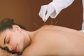 acupunctura jpg