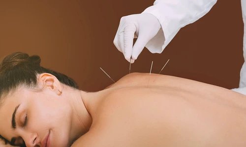 acupunctura jpg