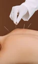 acupunctura jpg