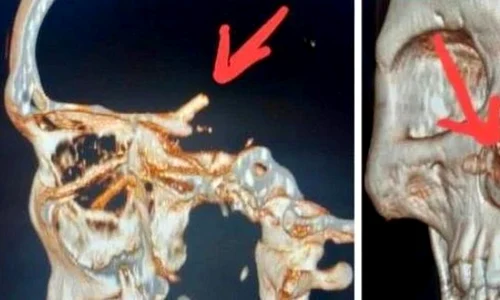 betisoare ct captura video jpg