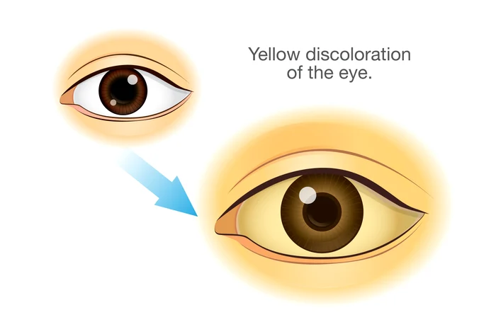 
    Ochii arată când ficatul are probleme  