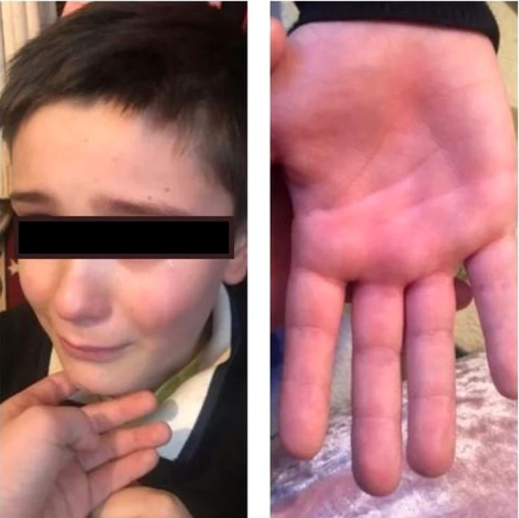 Copilul bătut cu bățul la palmă de învățător FOTO iasitvlife.ro