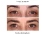 rezultat blefaroplastie iancu morad luxury aesthetics 7 jpg