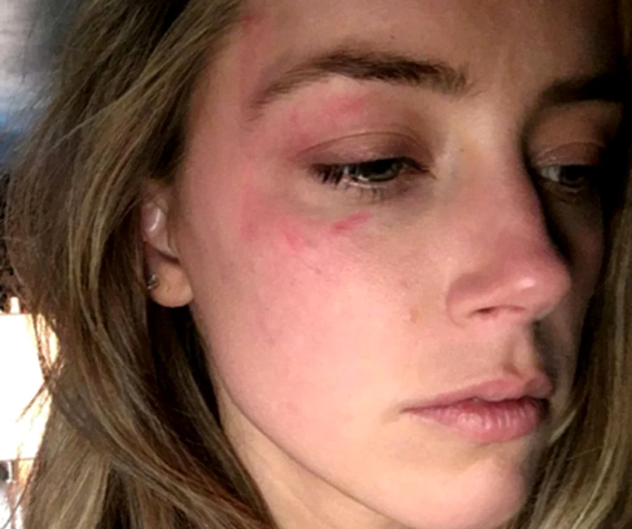 Amber Heard a fost bătută de Depp 