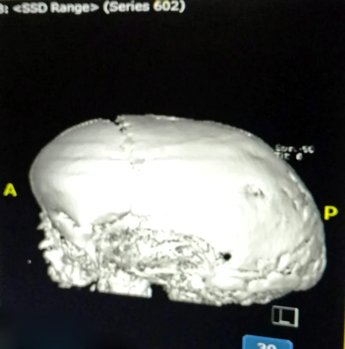 Medicii au desfăcut o bucată din craniul micuțului și l-au reatașat ca pe o piesă de puzzle