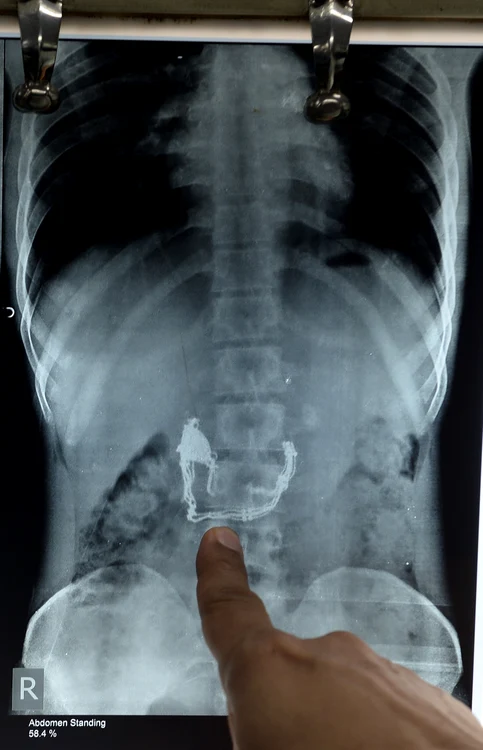 Radiografia l-a dat de gol pe tâlhar