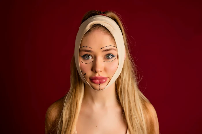 Buzele voluminoase sunt foarte inestetice. foto: Shutterstock