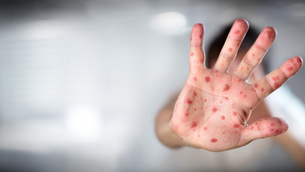 Numărul cazurilor de rujeolă a crescut cu 3.000% anul acesta, în Europa și Asia Centrală. Recomandările UNICEF 