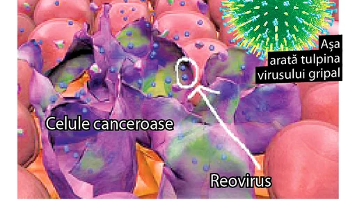 Gripa ucide  cancerul (foto: shutterstock) jpeg