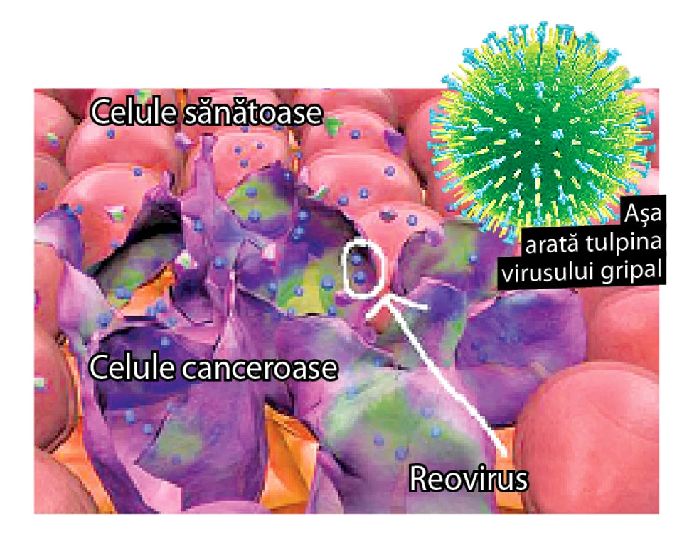 Gripa ucide  cancerul (foto: shutterstock)