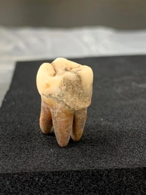 Exemplu de tartru dentar de pe un dinte uman din cimitirul Umeda