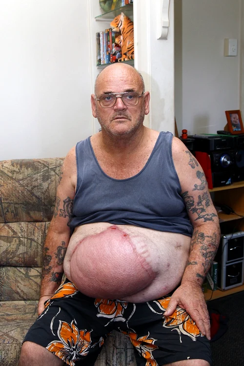 Îngrozitor! Uite ce i-a crescut în burtă, după ce a băut o bere care i-a căzut în râu