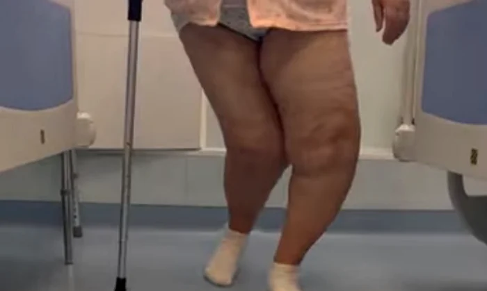 Femeia avea deformări grave la genunchi FOTO Captură video