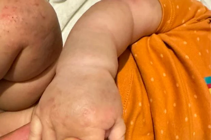 Medicii au confundat semnele din naştere cu vânătăi. FOTO: Laxmi Thapa