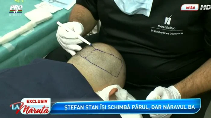 Stefan Stan şi-a facut implant de par