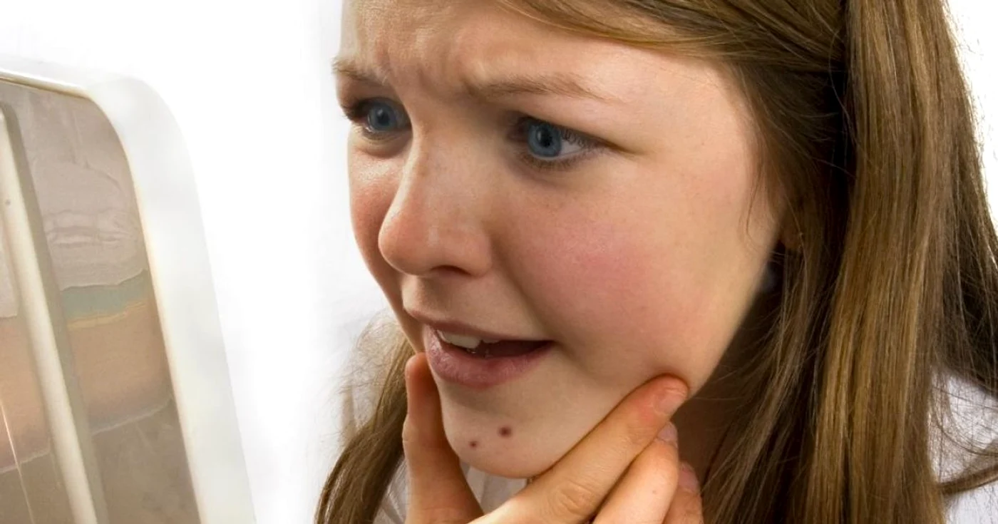 Acneea este o afecţiune ce atinge anual peste 76% dintre adolescenţii
