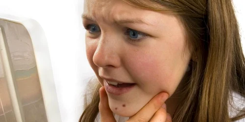Acneea este o afecţiune ce atinge anual peste 76% dintre adolescenţii
