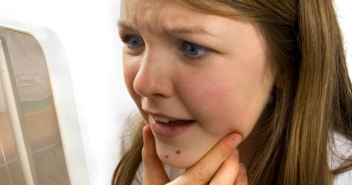 Acneea este o afecţiune ce atinge anual peste 76% dintre adolescenţii