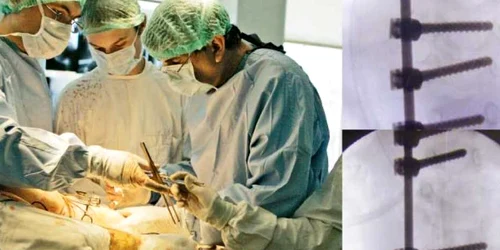 Din radiografie se observă cele şase şuruburi implantate de Profesorul Gheorghe Burnei (dreapta)
