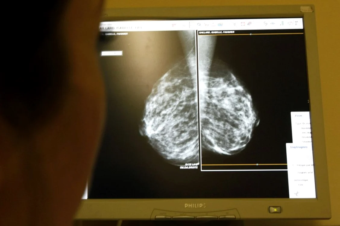 Prea puţine românce îşi fac mamografii pentru a depista timpuriu cancerul de sân FOTO Adevărul