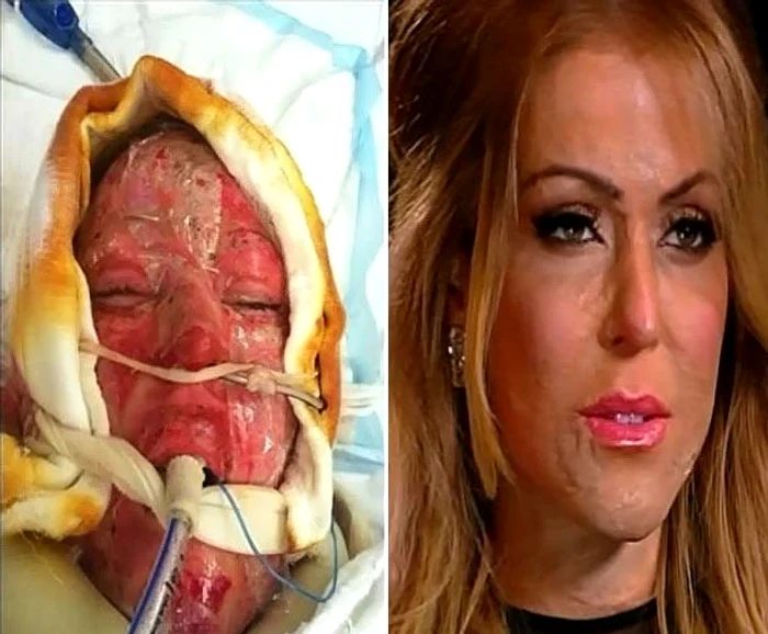 Dana Vulin a fost supusă la 30 de operaţii, iar acum arată normal