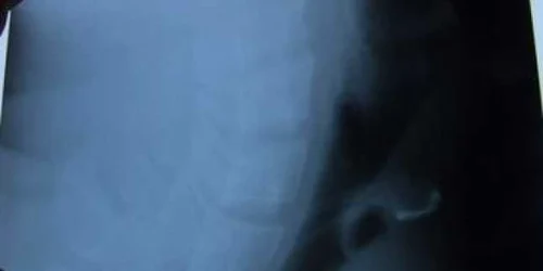 Iaşi: Un bărbat şi-a înghiţit dinţii