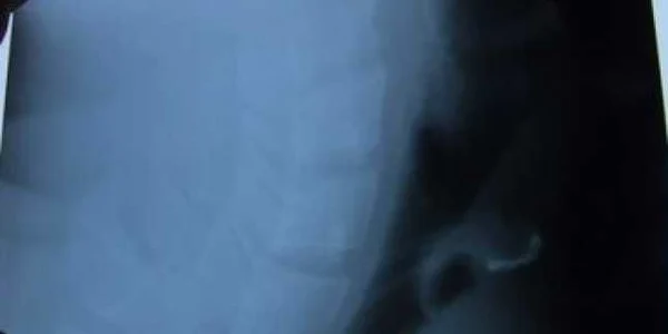Iaşi: Un bărbat şi-a înghiţit dinţii