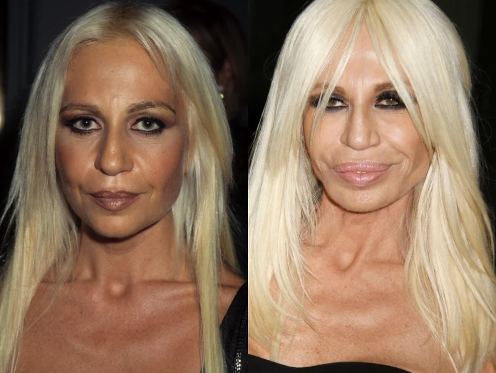 3 donatella varsace operati estetice jpg jpeg