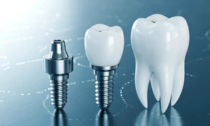 implant dentar   foto pixabay tamim jpg