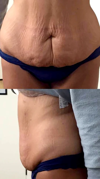 După ce a slăbit enorm, Amber a rămas cu piele în exces în zona abdomenului