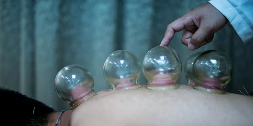 Un pacient beneficiază de un tratament cu ventuze aplicat de doctoral Eason Yu Kin Cho la o clinică de medicină chinezească în Hong Kong FOTO Guliver / GettyImages / Lam Yik Fei