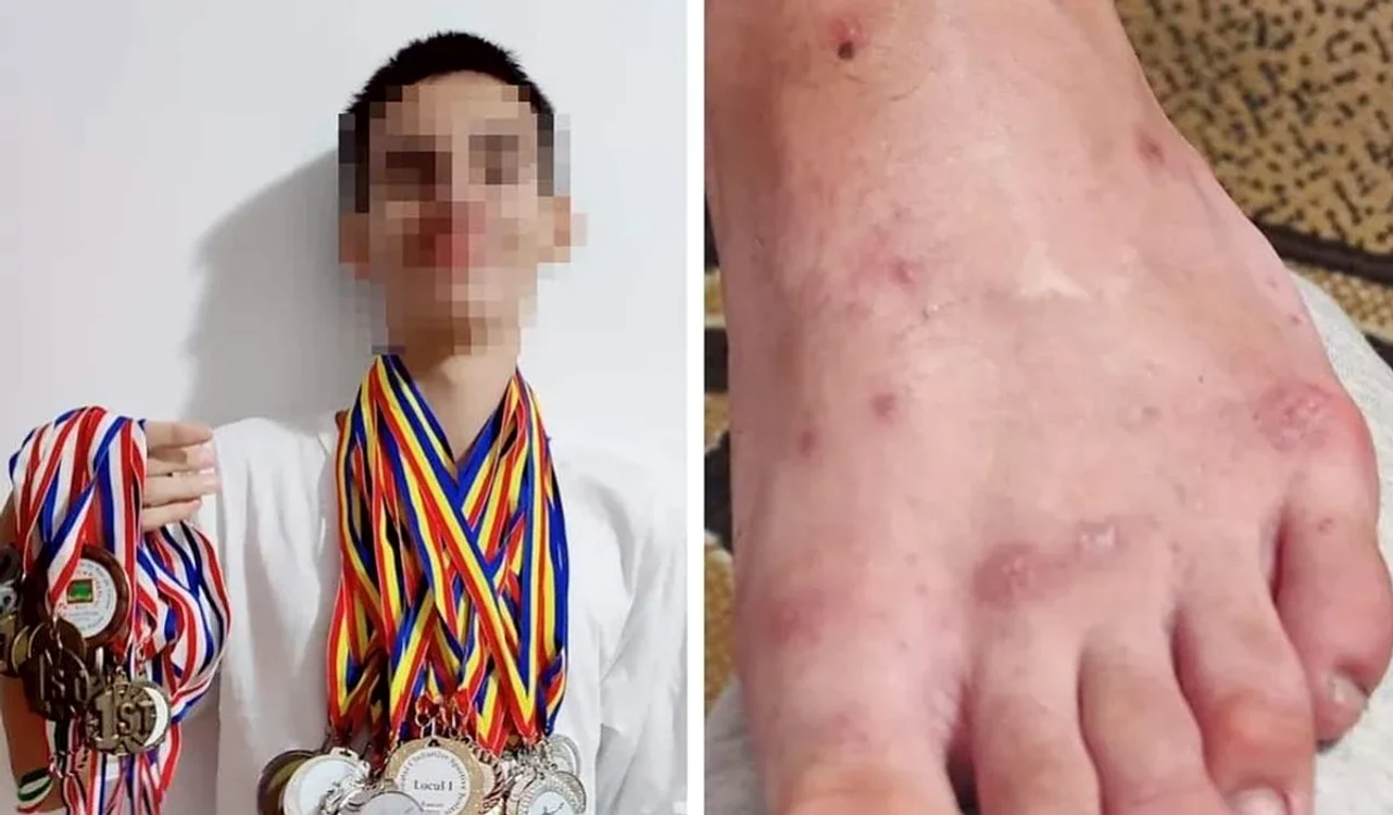 Mai mulți copii s-a infectat cu râie la Campionatele Naționale de Kaiac-Canoe / foto: oradesibiu