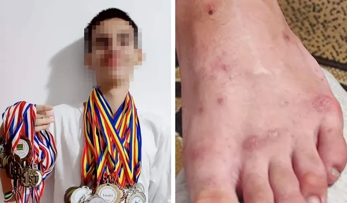 Mai mulți copii s-a infectat cu râie la Campionatele Naționale de Kaiac-Canoe / foto: oradesibiu