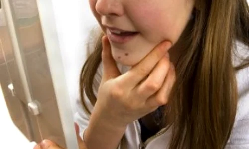 Există un tratament naturist pentru acnee şi coşuri jpeg