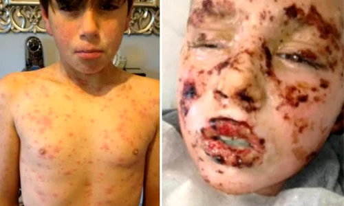 extreme allergic reaction 418074 jpeg